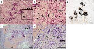 Maybe you would like to learn more about one of these? A Subset Of Malignant Mesothelioma Tumors Retain Osteogenic Potential Scientific Reports