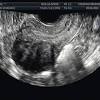Fibroid yang melekat pada rahim bisa menyebabkan rasa sakit, mual, atau demam. Https Encrypted Tbn0 Gstatic Com Images Q Tbn And9gcrc2nci44jdyqgonxn9mbqhopi7f Fqg8quxpnoq6klrydm3td Usqp Cau