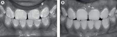 Scielo Brasil Dental Fluorosis Treatment Can Improve The Individuals Ohrqol Results From A Randomized Clinical Trial Dental Fluorosis Treatment Can Improve The Individuals Ohrqol Results From A Randomized Clinical Trial
