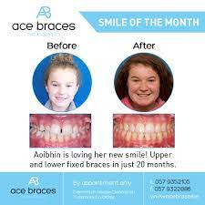 Patients experience soreness and need to get 1 arch (upper or lower) initial consolation is free (does not include a full dental check up) €1. Braces Ace Braces O Regan Orthodontics Teeth Straightening Ireland Braces Tullamore