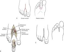 Image result for toe amputation