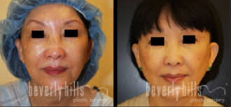 Secondary Facelift And Necklift Dr Chiu Beverly Hills Plastic Surgery Inc Cosmetic Surger Face Procedures Beverly Hills Plastic Surgery Plastic Surgery