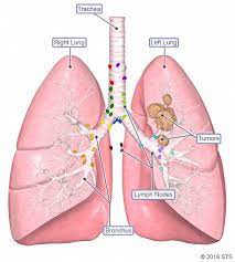 Even so, quitting offers benefits no matter how long you have smoked, reducing the facts are simple: Lung Cancer Newport Cardiac Thoracic Surgery