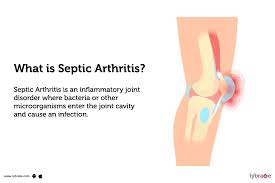 Image result for Septic Joint