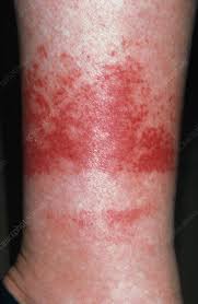 Purpura Rash On Woman S Leg Above Sock Line Stock Image M240 0221 Science Photo Library