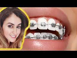 Less than $2 per whitening treatment. Hacks For Whiter Teeth With Braces Youtube