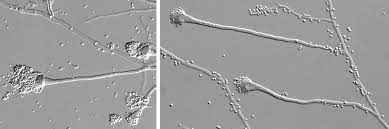 It generally occurs in people with lung diseases such as asthma, cystic fibrosis or tuberculosis, or those who have had a stem cell or organ transplant, and those who cannot fight infection because of m. Invasive Aspergillose Nrzmyk Nationales Referenzzentrum Fur Invasive Pilzinfektionen