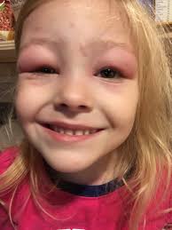 How to prevent mosquito bites in Cayman for a child with a severe reaction?