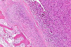 Then it can become more severe how do you know if you have cancer in your ear? Osteosarcoma Wikipedia