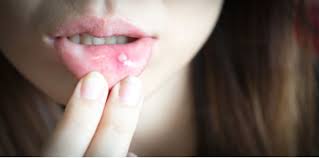 Ulser di mulut ini kebiasaannya muncul kerana badan kekurangan vitamin b12, vitamin c atau juga kekurangan zat besi selain dehidrasi kerana tidak meminum air secukupnya. Cara Merawat Ulser Mulut Sebelum Sapu Ubat Gel Ambil Tahu Ini Dulu