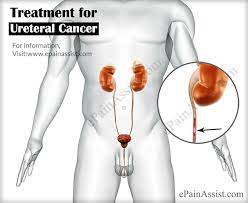 Surgical removal is the most common treatment, but chemotherapy and radiation. Ureteral Cancer Or Ureter Cancer Or Renal Pelvis Cancer Causes Symptoms Treatment