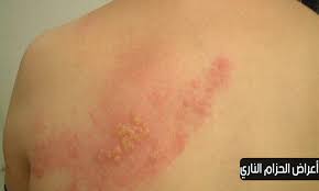 Herpes zoster / shingles)، هو التهاب فيروسيّ حاد في العصب وسطح الجلد المُحيط به الذي يُغذّيه هذا العصب، إذ يظهر على. ØµÙˆØª Ø·Ø¨Ù‚Ø© ÙƒÙˆÙ…Ø© Ø¹Ù„Ø§Ø¬ Ø§Ù„Ù…Ø±Ø¶ Ø§Ù„Ø­Ø²Ø§Ù… Ø§Ù„Ù†Ø§Ø±ÙŠ Guillotinpoilvet Com
