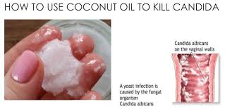 Most vaginal yeast infections do not produce a strong vaginal odor. Every Single Way To Use Coconut Oil To Reverse Yeast Infections And Any Feminine Hygiene Yeast Infection Relief Treat Yeast Infection Yeast Infection Treatment