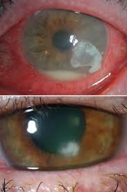 Image result for lesion sclera