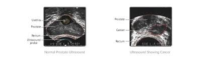 Being armed with information is vital to begin the fight. Prostate Biopsy University Urology Associates