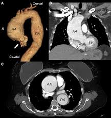 Image result for Cardiovascular Syphilis