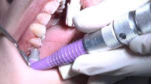 If you have dental insurance, most plans cover deep cleanings. Deep Cleaning At Dentist Youtube