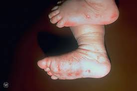 A bump on the bottom of the foot can be irritating or cause pain while walking. What Are Those Bumps On My Child S Skin