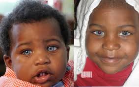 It appears that a genetic mutation in a single individual in europe 6,000 to 10,000. Haiti Cherie Black People With Blue Eyes