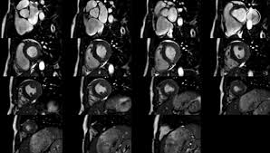 Motion artefacts arising from the heart and lungs are due to the cardiac cycle and the respiratory cycle. Cardiac Magnetic Resonance Assessment Of Myocarditis Circulation Cardiovascular Imaging