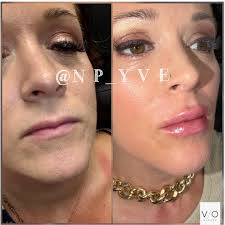 𝒀𝒗𝒆𝒕𝒕𝒆 𝑼𝒓𝒆𝒏𝒂- 𝑷𝒆𝒓𝒂𝒍𝒕𝒂, 𝑩𝒐𝒂𝒓𝒅 𝑪𝒆𝒓𝒕𝒊𝒇𝒊𝒆𝒅  𝑵𝒖𝒓𝒔𝒆 𝑷𝒓𝒂𝒄𝒕𝒊𝒕𝒊𝒐𝒏𝒆𝒓 (@np_yve) · New York, NY · Instagram  photos and videos