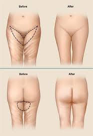Thigh Lift Charleston Cosmetic Surgery Body Lift Surgery Skin Removal Surgery Thighs