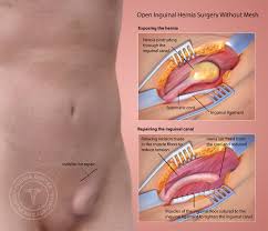 Image result for Inguinal hernia man