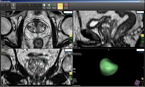 This illustration shows a normal prostate gland and a prostate with a tumor. Prostate Cancer Awareness Month Diagnostic Imaging Centers Kc