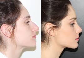 Rhinoplasty, commonly referred to as a nose job, is a surgical procedure that is used to alter the length, shape, contour of the nose, modify the nostrils, or lift and define the tip of the nose. Rhinoplasty And Nose Job For Android Apk Download