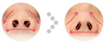 Scar tissues bulbous nose tip people who have had a previous nose job performed may experience the third type, which is caused by a build up of scar tissues in the tip of the nose. One Day Nose Job Rhinoplasty Non Incisional Tip Plasty Nose Job Wide Nose Nose Contouring