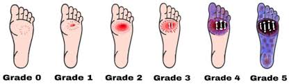 Image result for Wagner Ulcer Classification