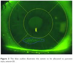 Full Text A Novel Scale For Describing Corneal Staining Opth