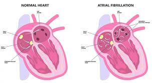 Image result for Atrial Fibrillation