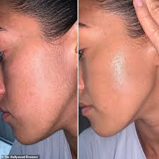 You intend to choose a clinic that is going to handle your procedure really well without any complications of pigmentation disorders, burns, scarring, blistering, redness, swellings, eye injury especially for eyebrows procedures and skin texture changes. Woman Praises 8 95 Dermaplaning Tool After Years Of Hair Removal Treatments Tech Readsector