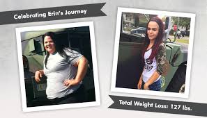 Before After Gastric Sleeve With Erin Gastric Sleeve Erin Bariatric Surgery