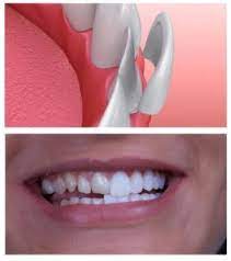 We did not find results for: Guide To The Types Of Veneers Cost In The Uk Muswell Hill Smile