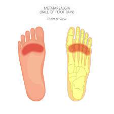 What Is Metatarsalgia Applied Biomechanics Orthotics Bracing Guelph