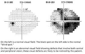Hi does anyone get flickering vision? What Is A Visual Field Test Glaucoma Research Foundation