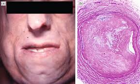Age-related Cardiovascular Changes and Diseases