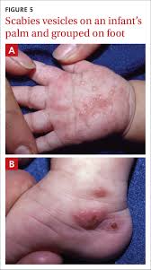 Image result for scabies in the groin area