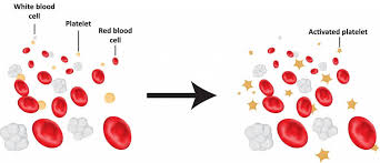 Check spelling or type a new query. Immature Platelet Fraction Ipf And Its Clinical Utility In Dengue