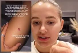 Molly-Mae Hague reveals she's had lumps removed from her breast and finger 