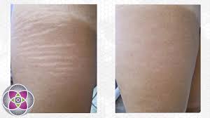 Frustrated after trying every lotion and potion without success. Laser Treatment To Remove Stretch Marks