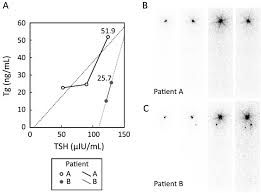 Serial Stimulated Thyroglobulin Measurements Are More