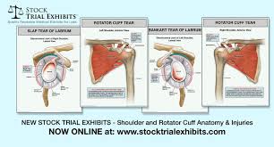 Rotator Cuff Full Thickness Tear Of The Left Shoulder Rotator Cuff Rotator Cuff Tear Rotator Cuff Injury