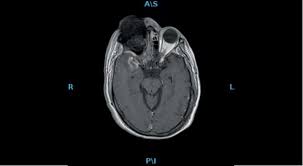 Rhino-orbital mucormycosis in a Mexican patient with COVID-19: Case report