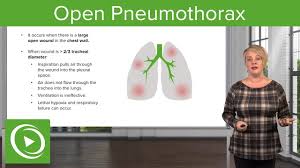 Image result for Open Pneumothorax