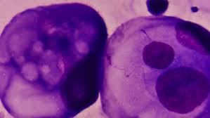 22.07.2020 · breast cancer and mesothelioma breast cancer, causes, and risk factors. Triple Negative Breast Cancer Treatment May Be On The Horizon