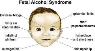 Flat nasal bridge and epicanthal folds : Alcohol Fetal Alcohol Syndrome