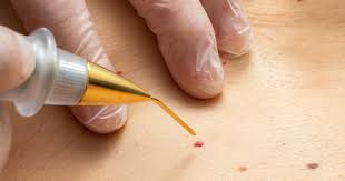 Skin Tag Removal With Laser: Your Path To Clear, Smooth Skin